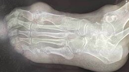 痛风性关节炎是什么原因引起的